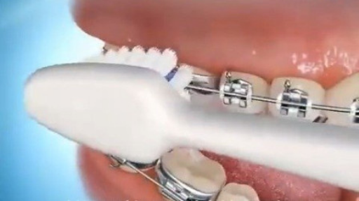 透明假牙套和假牙的区别,透明牙套效果怎么样
